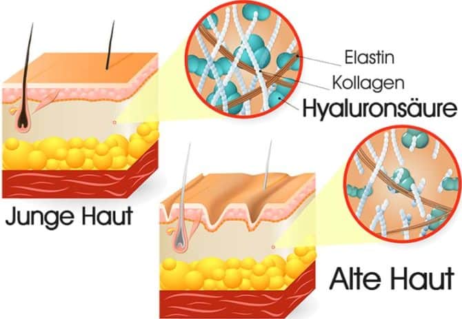 Hyaluronsäure
